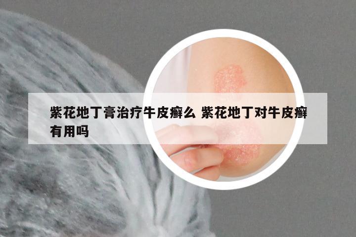 紫花地丁膏治疗牛皮癣么 紫花地丁对牛皮癣有用吗