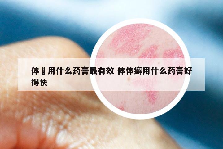 体廯用什么药膏最有效 体体癣用什么药膏好得快