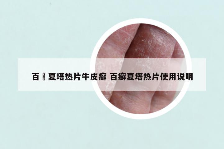 百廯夏塔热片牛皮癣 百癣夏塔热片使用说明