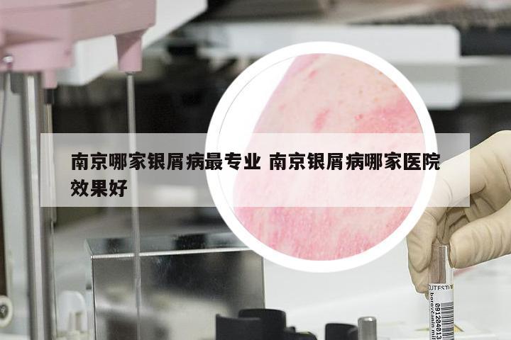 南京哪家银屑病最专业 南京银屑病哪家医院效果好