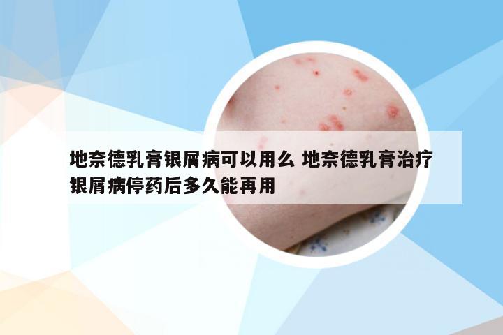 地奈德乳膏银屑病可以用么 地奈德乳膏治疗银屑病停药后多久能再用