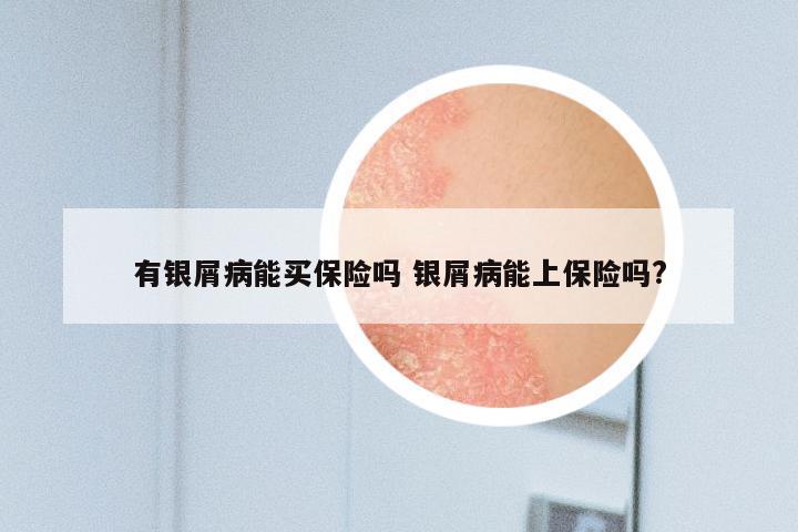 有银屑病能买保险吗 银屑病能上保险吗?