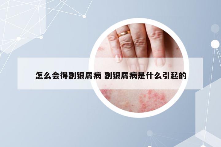 怎么会得副银屑病 副银屑病是什么引起的