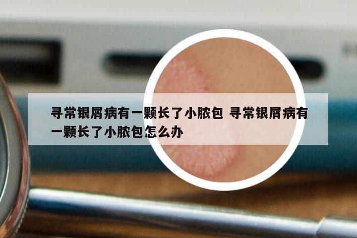 寻常银屑病有一颗长了小脓包 寻常银屑病有一颗长了小脓包怎么办