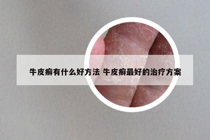 牛皮癣有什么好方法 牛皮癣最好的治疗方案