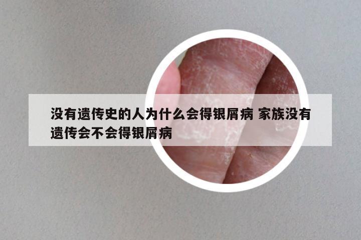 没有遗传史的人为什么会得银屑病 家族没有遗传会不会得银屑病