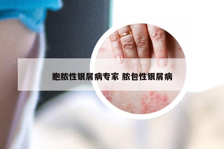 胞脓性银屑病专家 脓包性银屑病