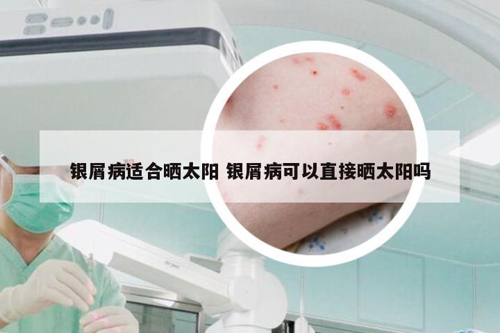 银屑病适合晒太阳 银屑病可以直接晒太阳吗