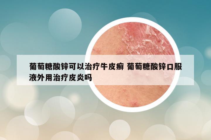 葡萄糖酸锌可以治疗牛皮癣 葡萄糖酸锌口服液外用治疗皮炎吗