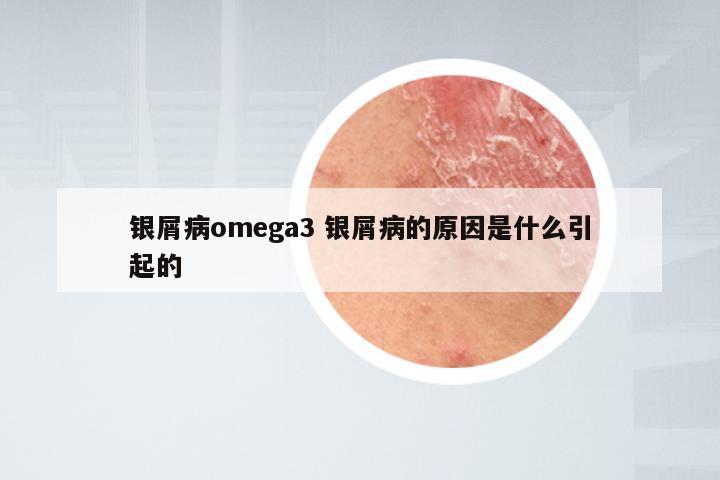 银屑病omega3 银屑病的原因是什么引起的