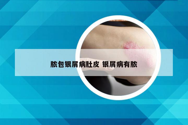 脓包银屑病肚皮 银屑病有脓