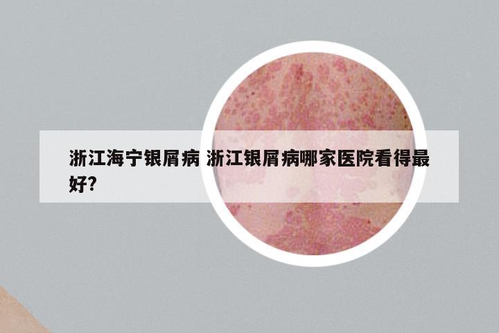 浙江海宁银屑病 浙江银屑病哪家医院看得最好?
