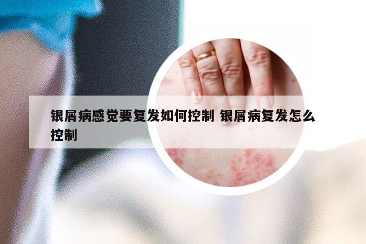 银屑病感觉要复发如何控制 银屑病复发怎么控制