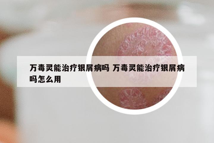 万毒灵能治疗银屑病吗 万毒灵能治疗银屑病吗怎么用