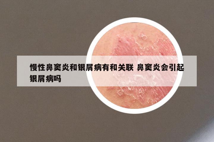 慢性鼻窦炎和银屑病有和关联 鼻窦炎会引起银屑病吗