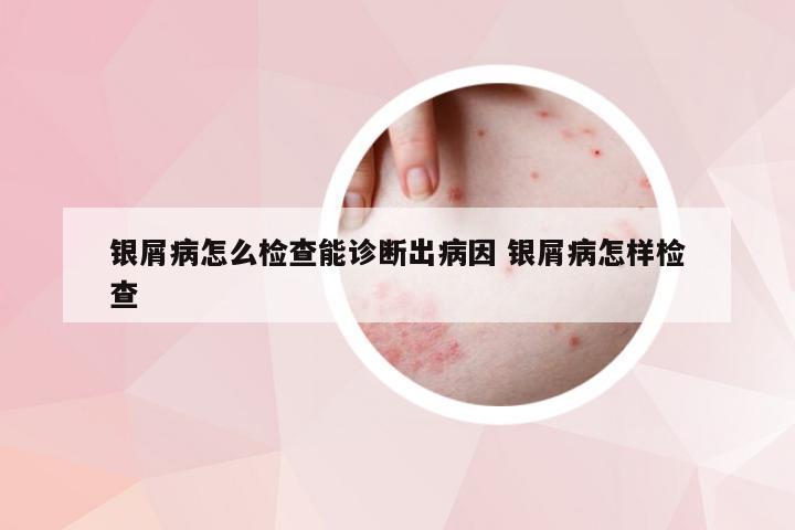 银屑病怎么检查能诊断出病因 银屑病怎样检查