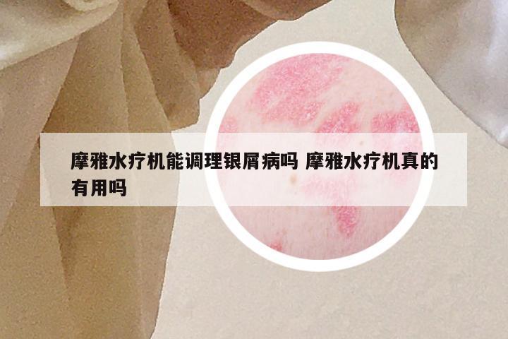 摩雅水疗机能调理银屑病吗 摩雅水疗机真的有用吗
