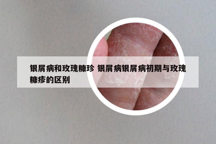 银屑病和玫瑰糠珍 银屑病银屑病初期与玫瑰糠疹的区别