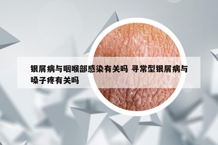 银屑病与咽喉部感染有关吗 寻常型银屑病与嗓子疼有关吗