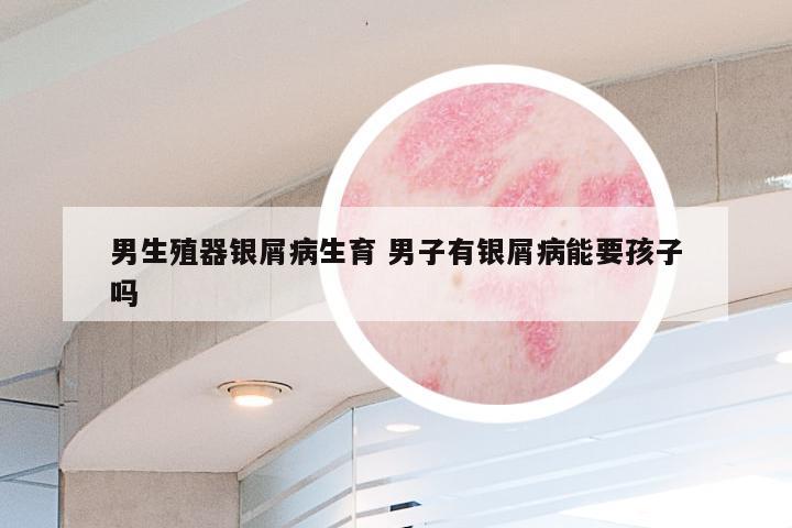 男生殖器银屑病生育 男子有银屑病能要孩子吗