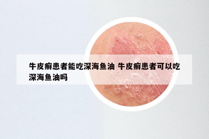 牛皮癣患者能吃深海鱼油 牛皮癣患者可以吃深海鱼油吗