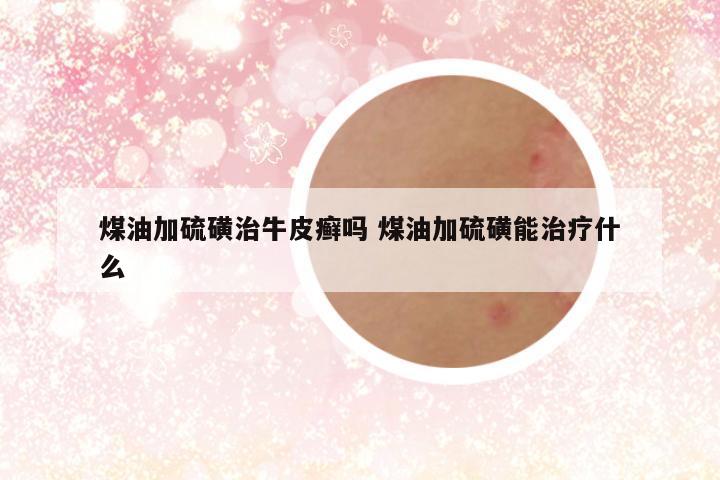 煤油加硫磺治牛皮癣吗 煤油加硫磺能治疗什么