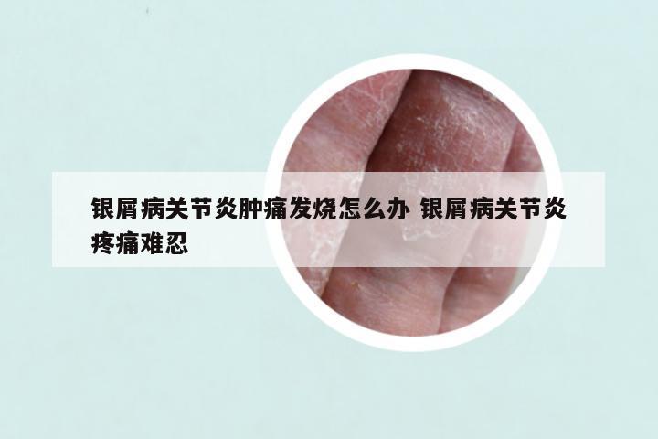 银屑病关节炎肿痛发烧怎么办 银屑病关节炎疼痛难忍