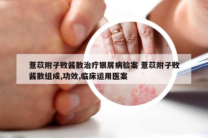 薏苡附子败酱散治疗银屑病验案 薏苡附子败酱散组成,功效,临床运用医案