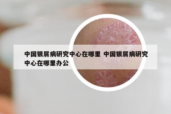 中国银屑病研究中心在哪里 中国银屑病研究中心在哪里办公