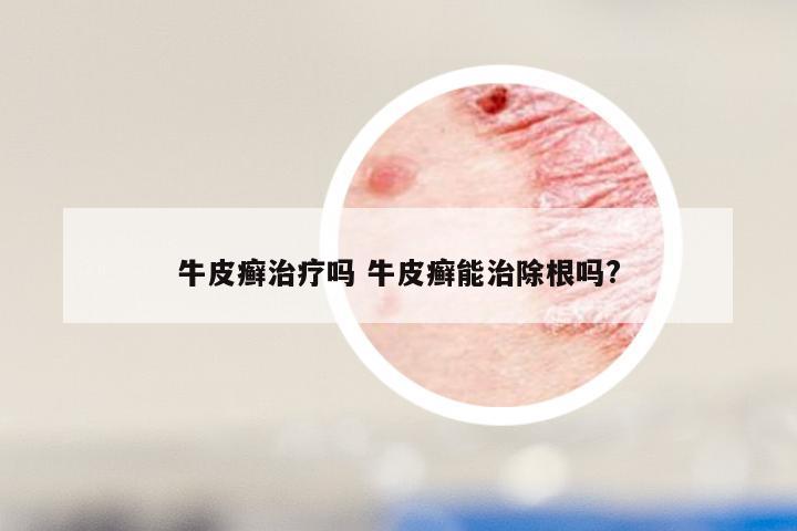 牛皮癣治疗吗 牛皮癣能治除根吗?
