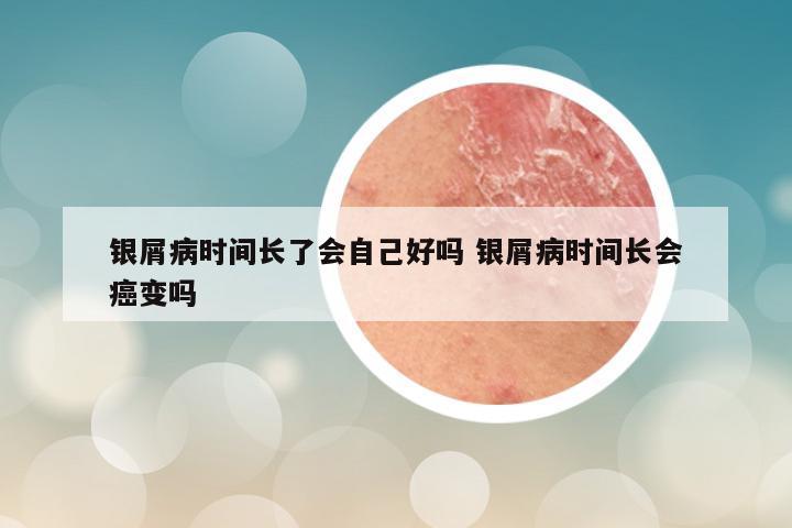 银屑病时间长了会自己好吗 银屑病时间长会癌变吗