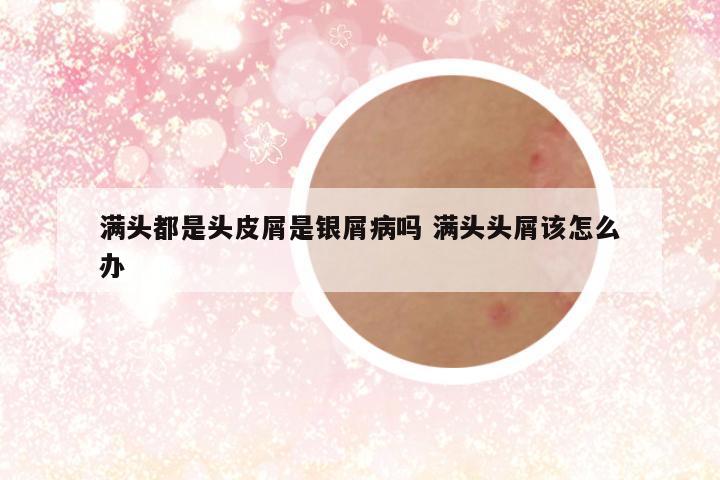 满头都是头皮屑是银屑病吗 满头头屑该怎么办