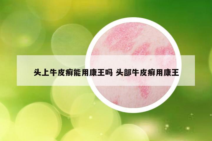 头上牛皮癣能用康王吗 头部牛皮癣用康王