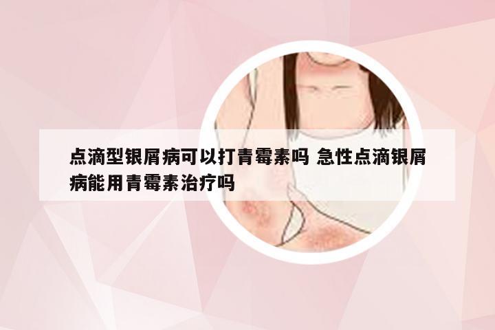点滴型银屑病可以打青霉素吗 急性点滴银屑病能用青霉素治疗吗