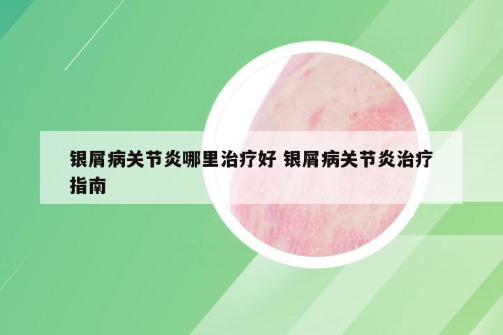 银屑病关节炎哪里治疗好 银屑病关节炎治疗指南