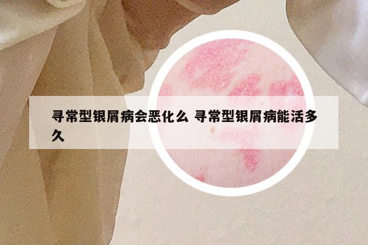 寻常型银屑病会恶化么 寻常型银屑病能活多久