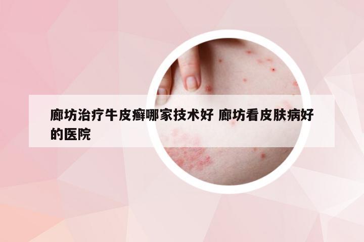 廊坊治疗牛皮癣哪家技术好 廊坊看皮肤病好的医院