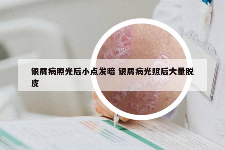 银屑病照光后小点发暗 银屑病光照后大量脱皮