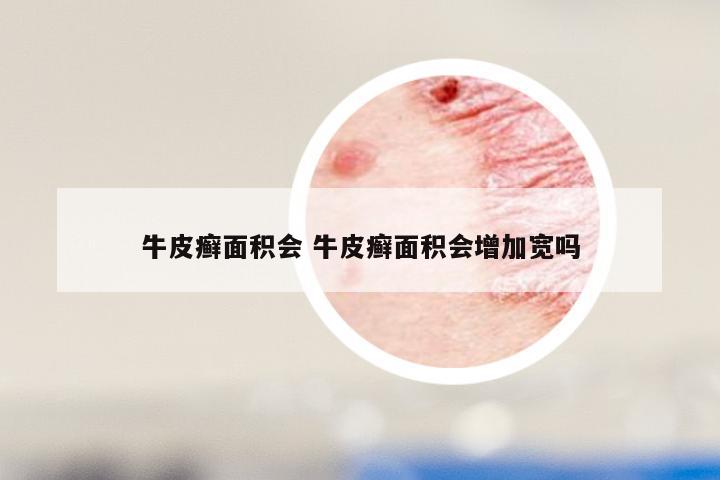 牛皮癣面积会 牛皮癣面积会增加宽吗