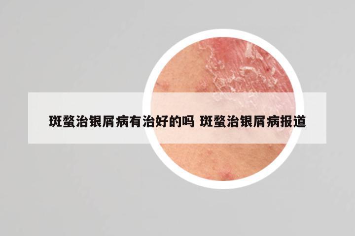 斑蝥治银屑病有治好的吗 斑蝥治银屑病报道