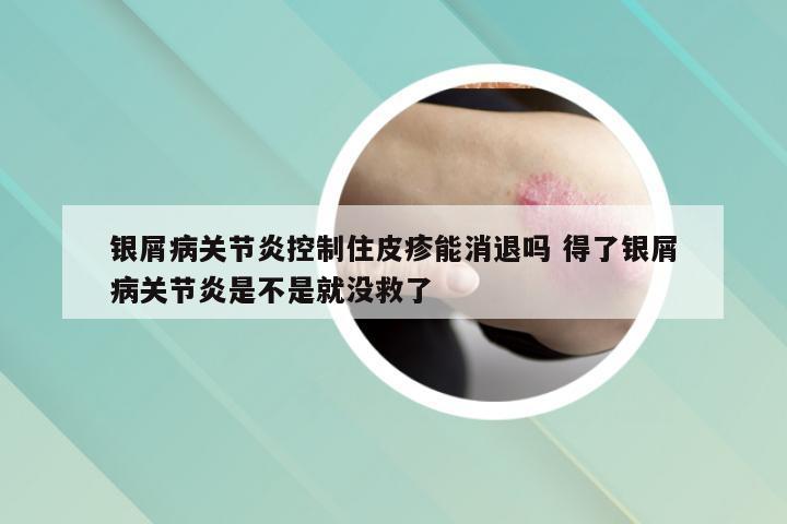 银屑病关节炎控制住皮疹能消退吗 得了银屑病关节炎是不是就没救了