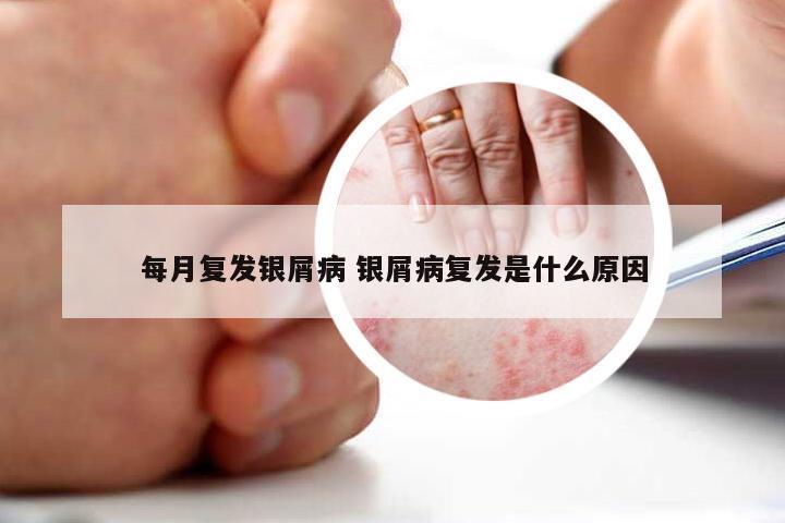 每月复发银屑病 银屑病复发是什么原因