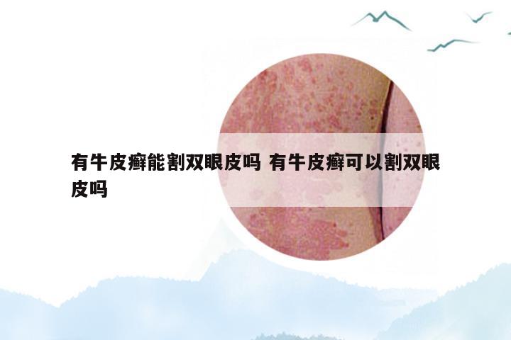有牛皮癣能割双眼皮吗 有牛皮癣可以割双眼皮吗
