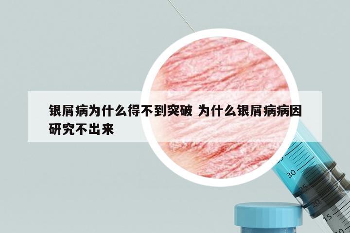 银屑病为什么得不到突破 为什么银屑病病因研究不出来