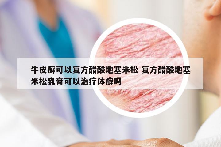 牛皮癣可以复方醋酸地塞米松 复方醋酸地塞米松乳膏可以治疗体癣吗