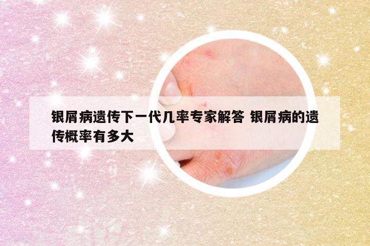 银屑病遗传下一代几率专家解答 银屑病的遗传概率有多大