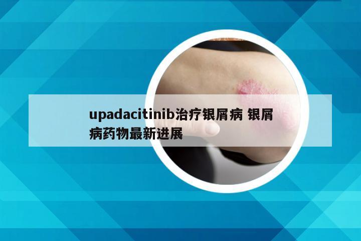 upadacitinib治疗银屑病 银屑病药物最新进展