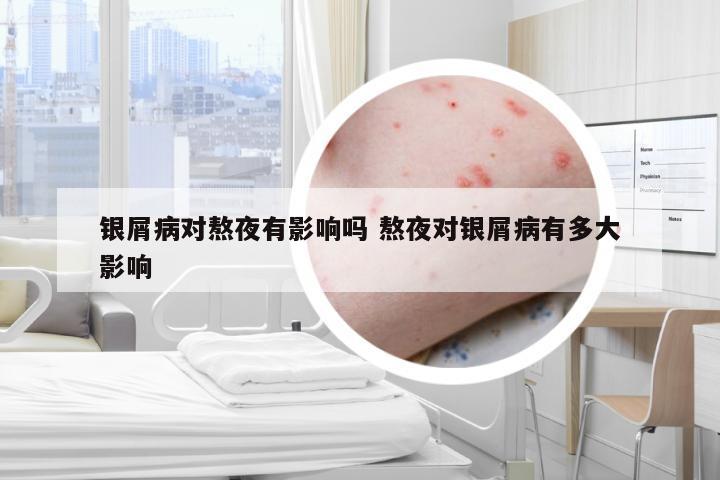 银屑病对熬夜有影响吗 熬夜对银屑病有多大影响
