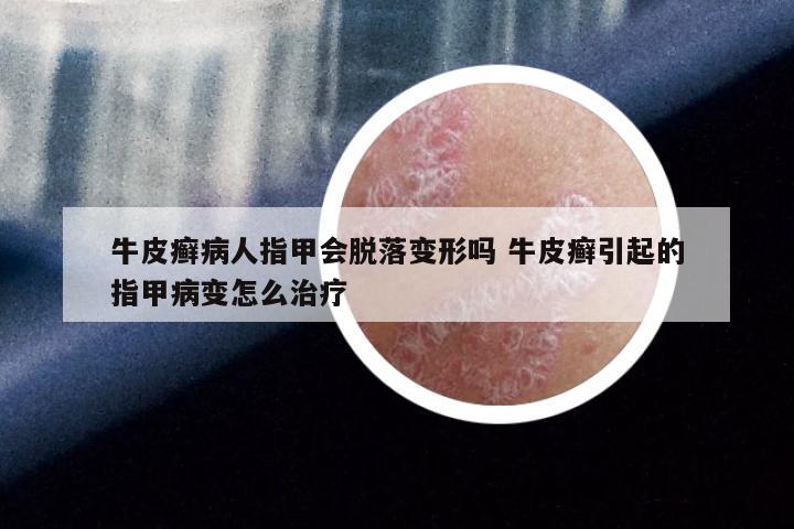 牛皮癣病人指甲会脱落变形吗 牛皮癣引起的指甲病变怎么治疗