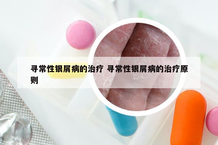 寻常性银屑病的治疗 寻常性银屑病的治疗原则
